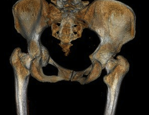 Hip Protrusio CT Medial Wall Intact 2